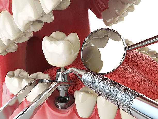 Best Emergency Root Canal Treatment in Anahola, HI